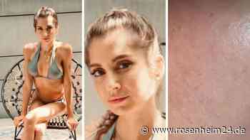 „Was keiner weiß“: Cathy Hummels zeigt ihren Followern juckendes Haut-Problem