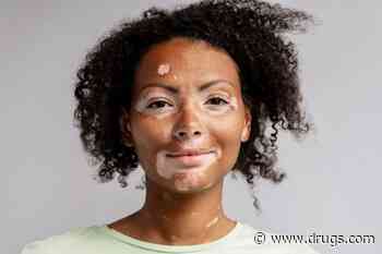 Incidence Rate of Diagnosed Vitiligo 22.6 per 100,000 Person-Years
