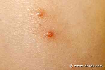 FDA Approves Topical Treatment for Molluscum Contagiosum