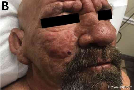 Leprosy could become endemic in Florida as cases rise, CDC says