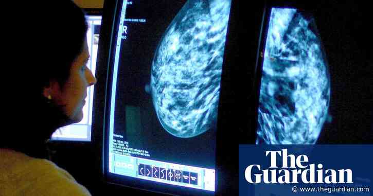 AI use in breast cancer screening as good as two radiologists, study finds