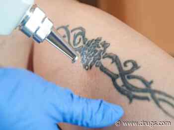 Tattoo Regret? Here's Tips on Safely Getting Old 'Ink' Removed