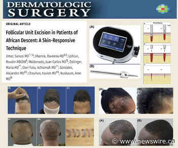 Revolutionaire techniek biedt hoop voor haarrestauratie bij mensen van Afrikaanse afkomst