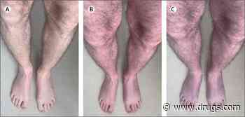 Long COVID Triggered One Man's 'Blue Legs' Syndrome