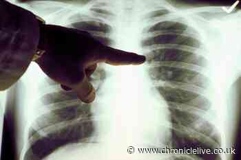Easy finger test you can do at home to check for early signs of lung cancer