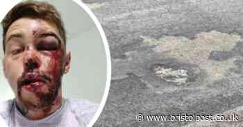 'Fit' cyclist hits pothole in pretty tourist city and is left with facial deformities and 'unable to eat'