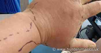 Man almost loses hand after treating false widow spider bite himself