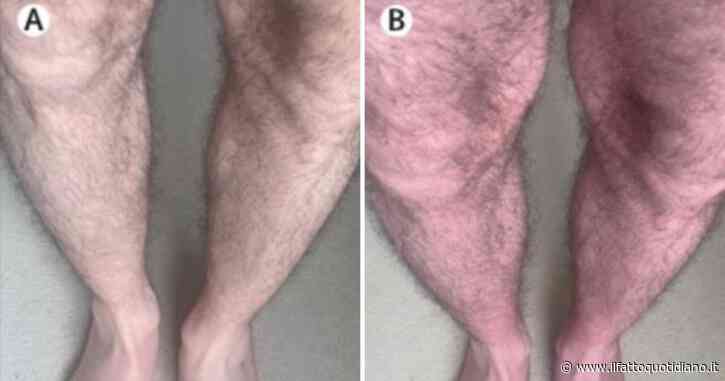 Le gambe gli diventano viola e ha dei formicolii ogni volta che sta in piedi, se si sdraia tornano normali: la storia di un 33enne diventa un caso studio