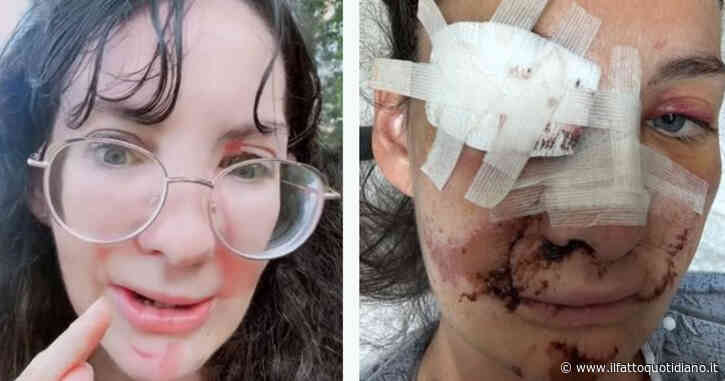 Travolta dalle balle di fieno mentre dà da mangiare ai cavalli si ritrova con il volto sfigurato: “Il naso mi è rimasto in mano”