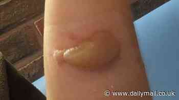 Gardener in Dorset is left with 'very painful' blisters after accidentally rubbing cow parsnip on her bare arm