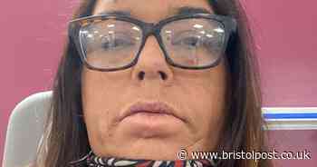 Woman living with a rare disease that started as childhood cold sore