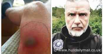 Horror false widow spider bite leaves dad needing hospital treatment