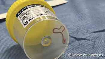 Live, wriggling worm pulled from brain of woman hospitalized with 'mystery illness'