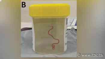 Neurosurgeon plucks live worm from woman's brain after months of mysterious symptoms