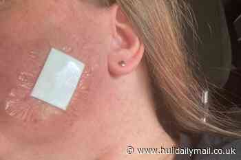 Sunbed shop worker offered free tanning with job gets skin cancer