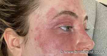 Woman left with 'elephant skin' all over body after getting veneers