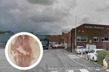 Woman burned while working at Herbert Parkinson in Darwen