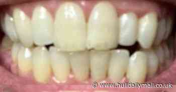 Teeth whitening strips that 'remove coffee and wine stains' for under £23 praised by shoppers