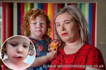 Nelson girl, 4, ‘scarred for life’ after dog bites her on face