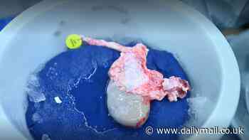 Pig kidney transplanted in a human lasted for TWO MONTHS in new record that could be a breakthrough for organ donations