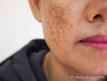 Melasma: New Dark Patches or Freckling -- A Dermatologist Offers Tips on Dealing With It