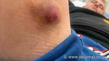 'Britain's most dangerous spider' strikes in Essex: Man's leg swells up like a balloon after a 'horrific' bite from a noble false widow