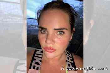 Wirral nurse diagnosed with skin cancer after finding ‘white lump’