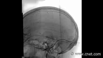 You Might Not Need Open Brain Surgery to Get Mind Control     - CNET