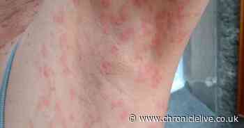 Surprising Covid symptoms you need to watch out for as Pirola cases rise