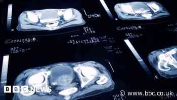 Prostate cancer trial: Radiotherapy doses can be cut safely
