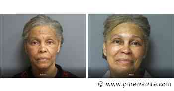 Aesthetic Plastic Surgery &amp; Laser Center Announces Fraxel Duo Laser's Effectiveness in Treating Melasma