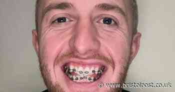 'I chose braces in my 30s over Turkey teeth - I don't regret my decision despite trolls'