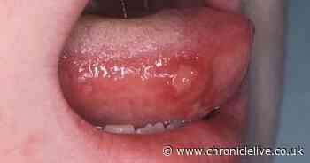 Symptoms of hand, foot and mouth disease you need to look out for and how to treat it