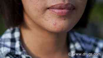 Women With Acne Bear Another Burden: Stigma