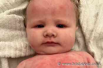 'My baby's eczema was so bad it caused her to bleed and her skin to weep - TikTok solution cured her'