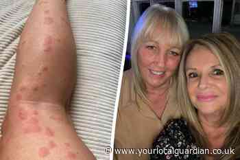 British holidaymaker scarred from 200 bedbug bites