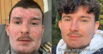 Rhys was bedbound by eczema, but sister's product changed his life