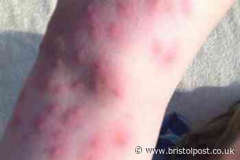 UK bedbug hotspots - towns and cities most worried about infestation