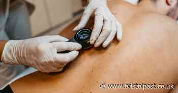 Scientist says more people are dying from lesser-known skin cancer that isn't melanoma