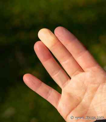 Scientists Spot Genes Linked to Raynaud's Phenomenon