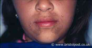 Warning issued over ultra-rare 'disturbing' disease that turns parts of your body black