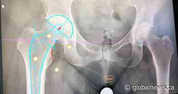 ‘Bone-on-bone pain’: B.C. woman pays for private hip surgery in Alberta