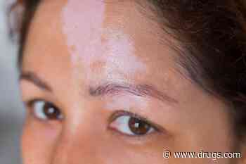 Half of Patients With Newly Diagnosed Vitiligo Do Not Receive Treatment