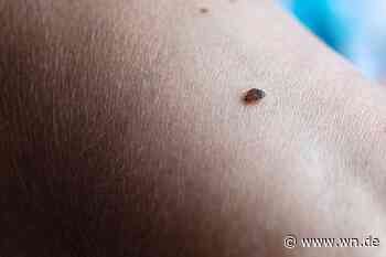 Bettwanzenstiche jucken meistens nur