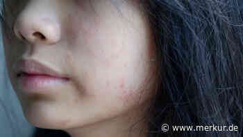 Akne im Erwachsenenalter: Ursachen eines weit verbreiteten Problems