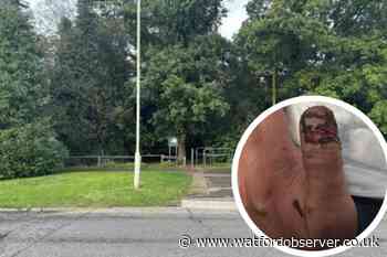 'Terrifying' Woodside Playing Fields dog attack injures man and pet