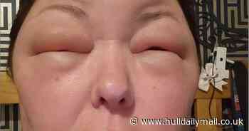 Gran's face balloons 'like a bowling ball' - as horror L'Oreal hair dye reaction leaves her blind for days