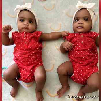 WATCH:  Formerly conjoined twin sisters celebrate 1st birthday