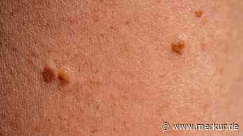 Hautkrebs rechtzeitig erkennen: ABCDE-Check verrät, wann Sie zum Arzt sollten