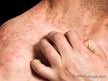 Lymphoid Reaction Observed in Eczema Patients Receiving Dupilumab